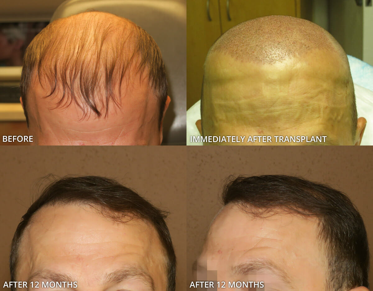 FUE Hair Transplantation – Before and After Pictures