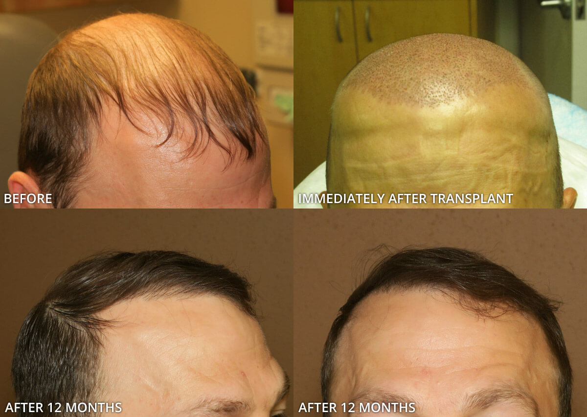 FUE Hair Transplantation – Before and After Pictures