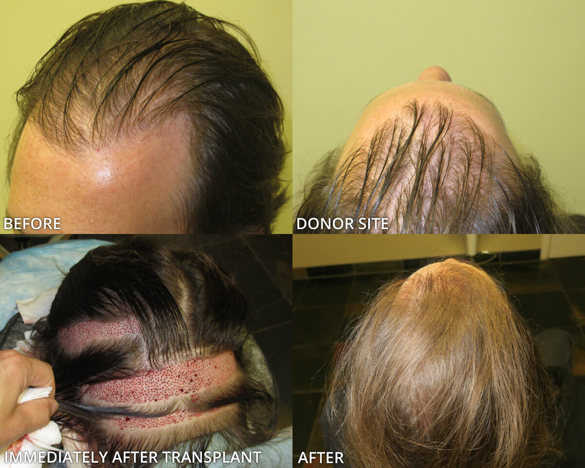 FUE Hair Transplantation – Before and After Pictures