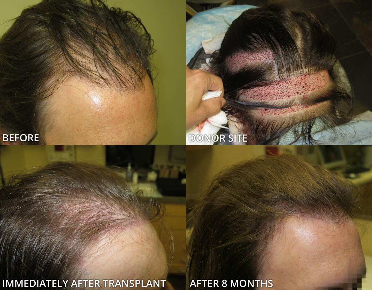 FUE Hair Transplantation – Before and After Pictures