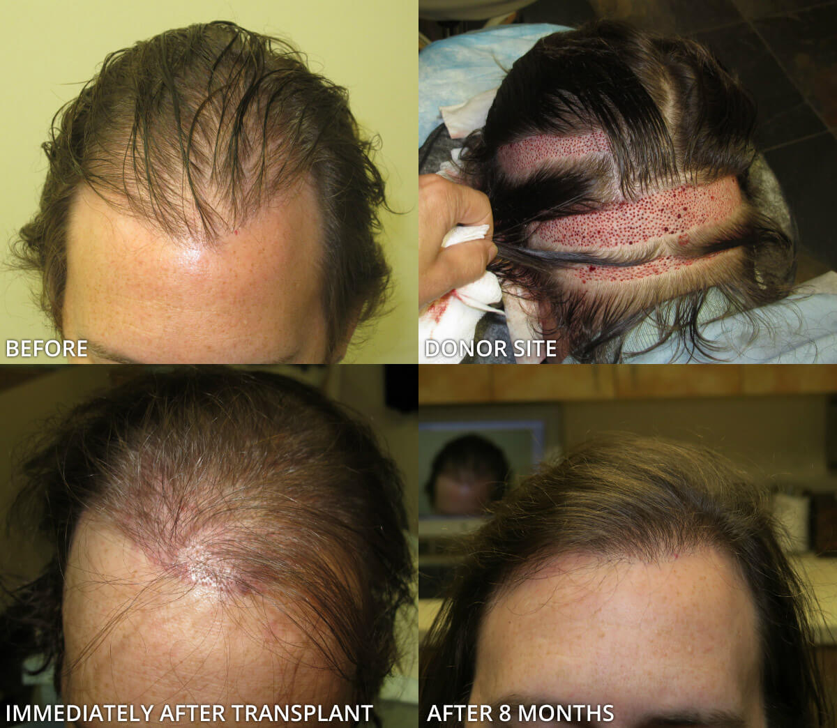 FUE Hair Transplantation – Before and After Pictures