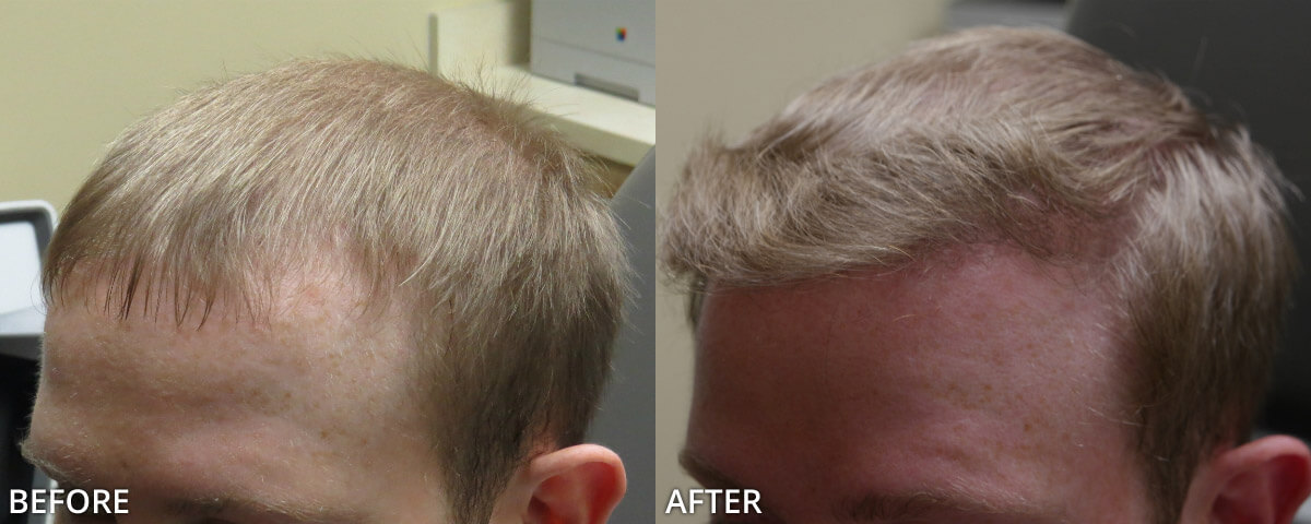 FUE Hair Transplantation – Before and After Pictures