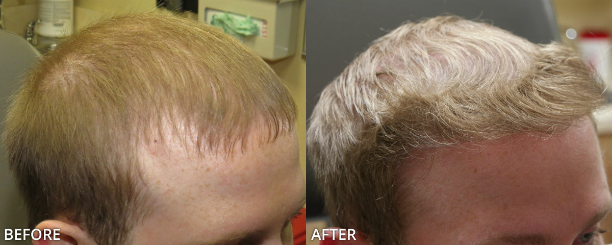 FUE Hair Transplantation – Before and After Pictures