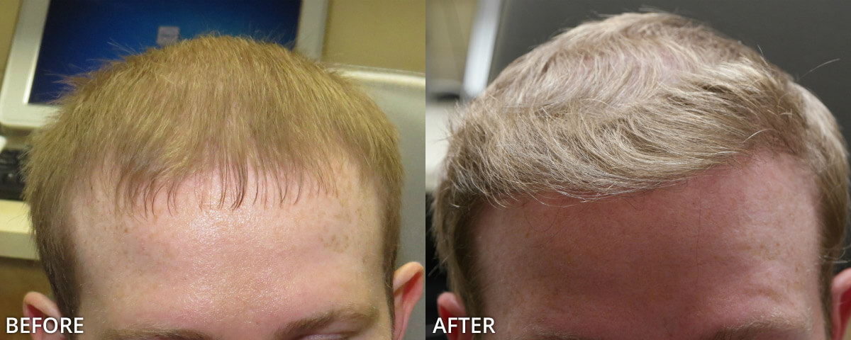 FUE Hair Transplantation – Before and After Pictures