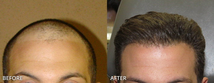 FUE Hair Transplantation – Before and After Pictures