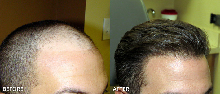 FUE Hair Transplantation – Before and After Pictures