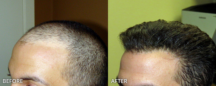 FUE Hair Transplantation – Before and After Pictures