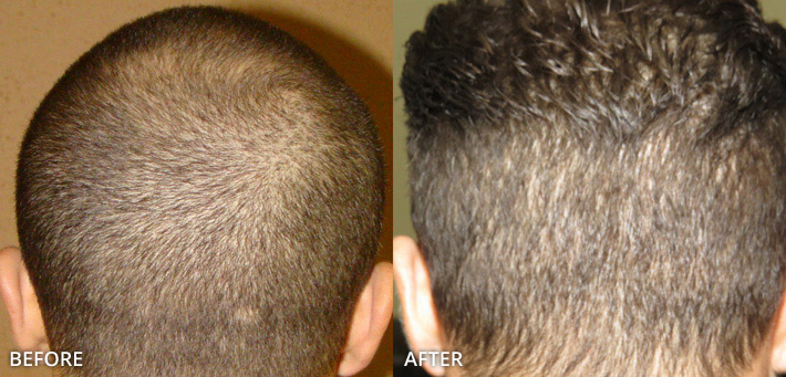 FUE Hair Transplantation – Before and After Pictures