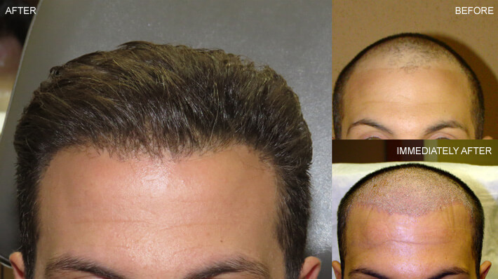 FUE Hair Transplantation – Before and After Pictures