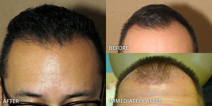 FUE Hair Transplantation – Before and After Pictures