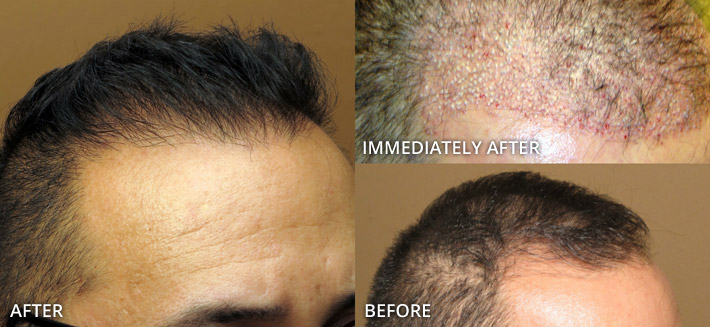 FUE Hair Transplantation – Before and After Pictures