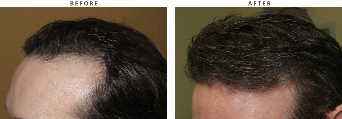 Robotic Hair Transplant - Before and After Pictures