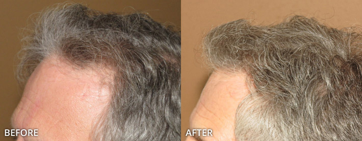 FUE Hair Transplantation – Before and After Pictures