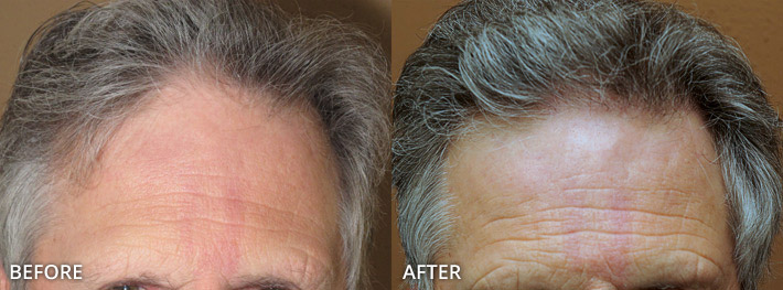 FUE Hair Transplantation – Before and After Pictures