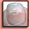 Fingernail disorder: leukonychia.