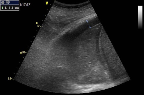 pl effusion measurement