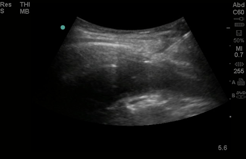 Wire in effusion 1