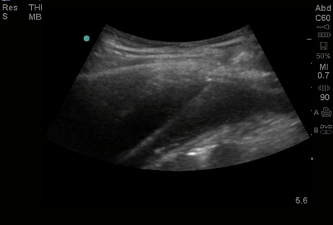 Wire in effusion