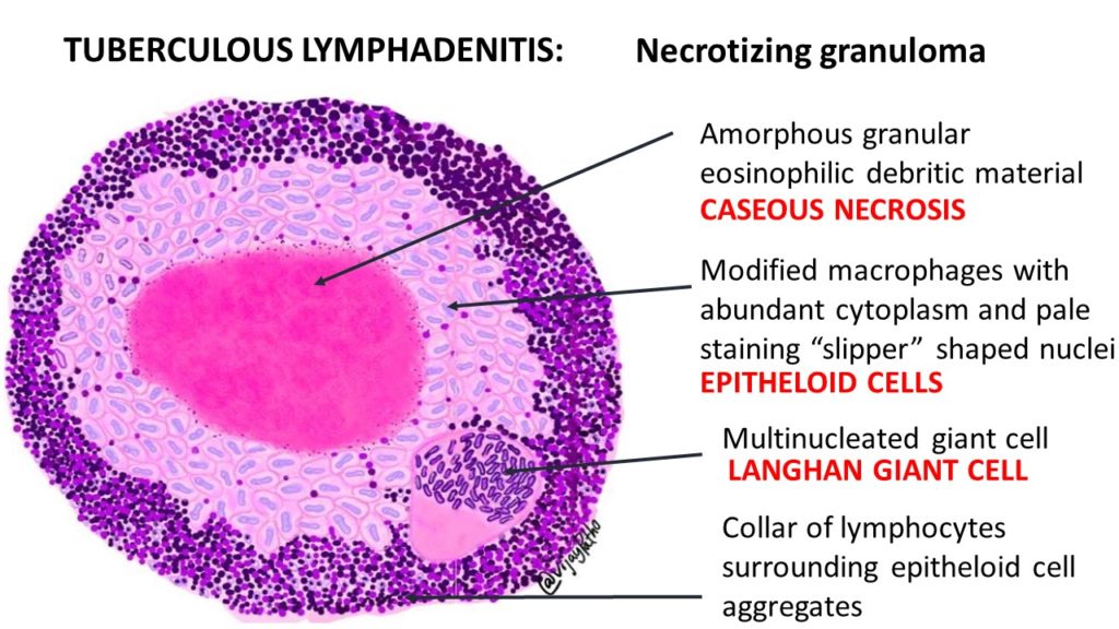 Caseous necrosis