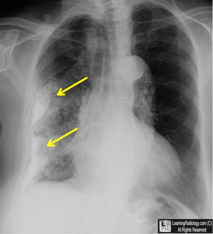 Tuberculous Empyema