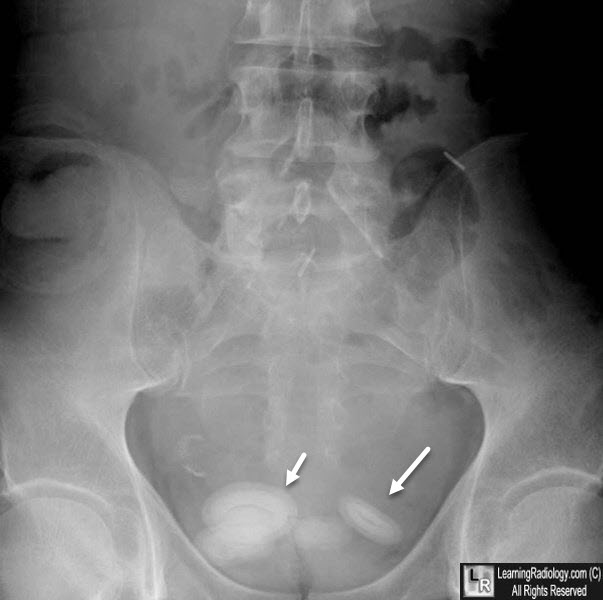 Bladder Calculi