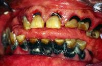 Iron Staining Teeth