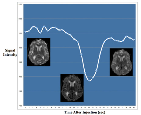 gadolinium bolus DSC