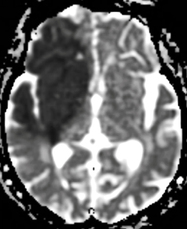 ADC map infarction