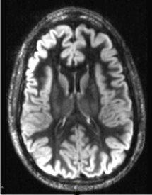 Double IR brain