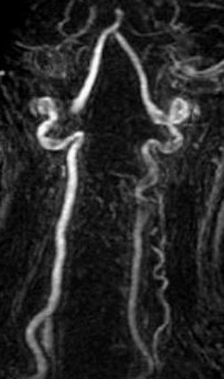 Flow-Reversal Pitfall TOF MRA