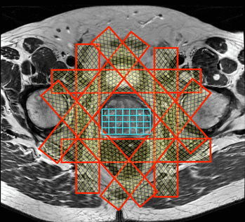 Prostate MRS setup