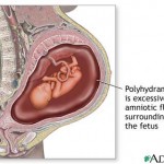 Polyhydramnios Image