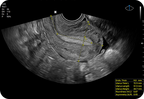 women's care in obstetrics and gynecology : UterineAssist™