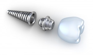 Dental Implant