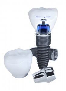 Maintaining Your Tooth Implant