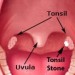 Tonsil-Stones