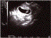 ultrasound1-s2.gif