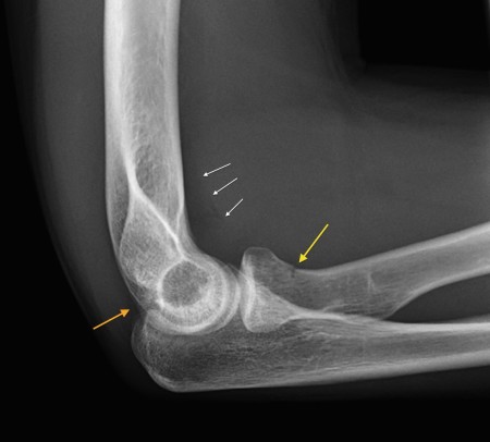 Radial neck fracture