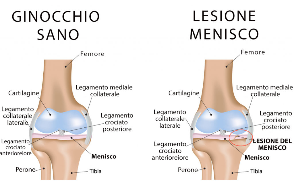 Lesione menisco