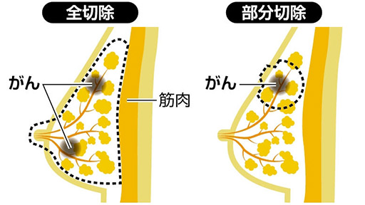 乳がん　全切除が増加傾向