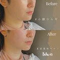 小顔コルギBeforeAfter♪