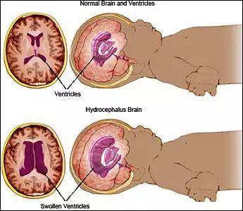 脑积水