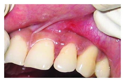 Closure of interdental papilla 6 months postoperatively. | Download ...