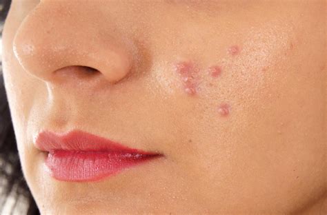 Acne Papules Treatment