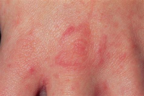 Scabies Symptoms Causes Treatment Preventions - Symptom Clinic