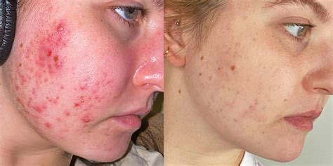 My 8-Month Accutane Journey With Side Effects and Results - Business ...