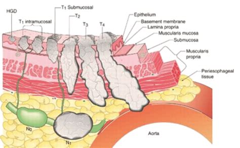 TN Staging of Esophageal Cancer. © Copyright 2001-2015. 1800 Orleans ...