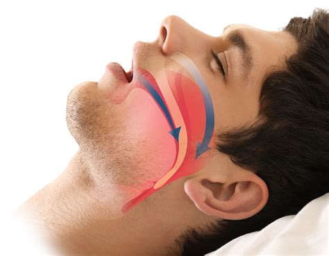 Sleep Apnea Side Effects - Edmonton, AB - DentaCare Group