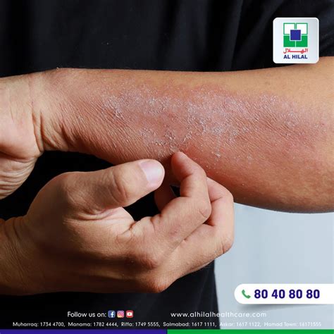 Dermatitis: Symptoms, Diagnosis, Treatment, and Prevention