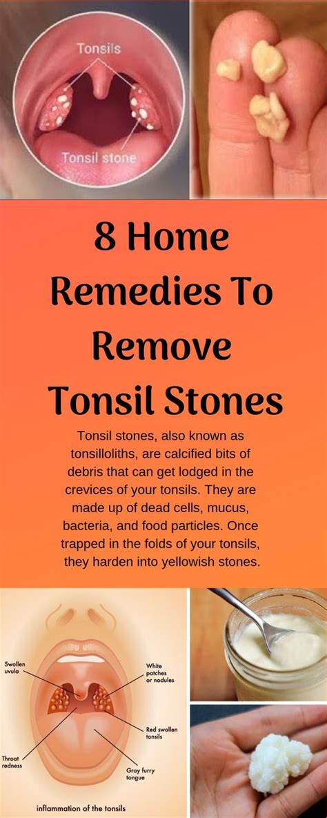 How To Get Rid Of White Spots On Tonsils Causes Home Remedies Home ...